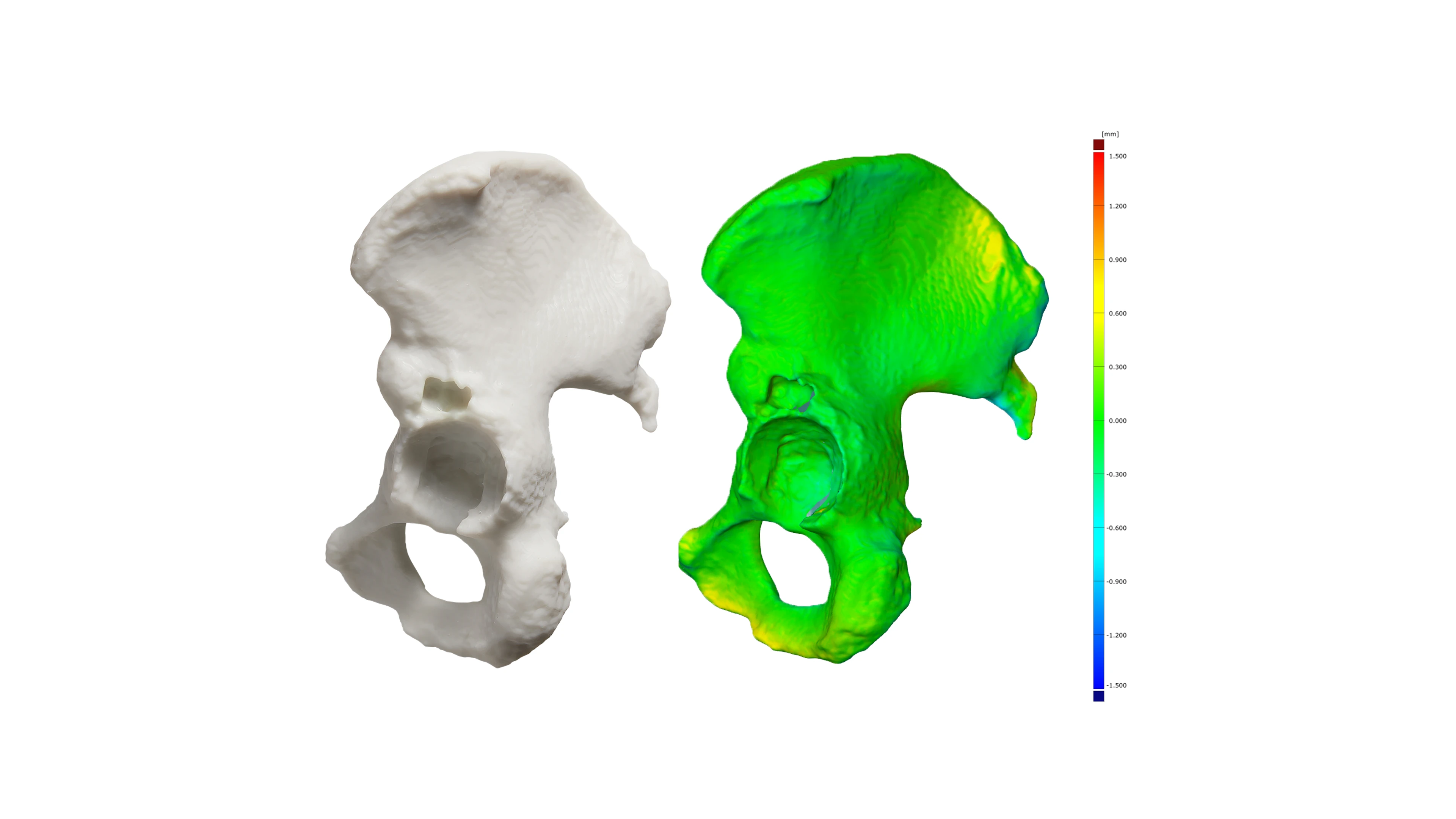 Form 4B ile basılmış pelvis modeli ve CAD yüzeyine göre renkli sapma haritası